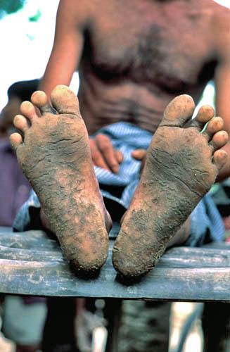 23 Keratosis of the Feet - (India Arsenic West Bengal Box 4 File 7 2 ns 28)