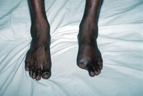 25 Arsenicosis Sufferer toe removed onset of Gangrene - (Bangladesh Arsenic Box 4 File 7 6ns 11)
