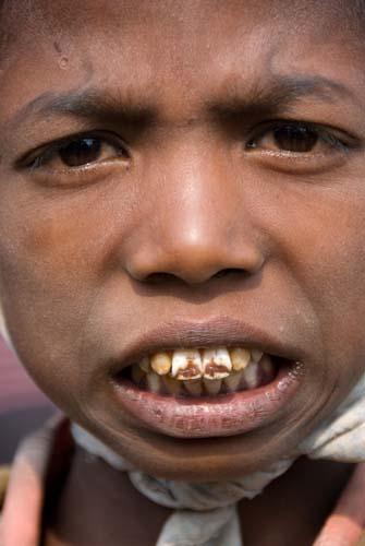 Dental Fluorosis - DSC_0129 DVD India Bihar Rural Lifestyle Boy - Teeth suffering from Fluorosis