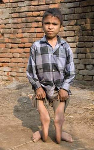 An Agonising Life Ahead _DSC0170 DVD India Bihar Rural Lifestyle Child suffering from Fluorosis 