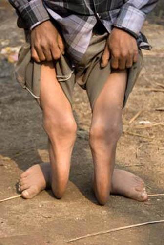 Too Much Too Late_DSC0171 DVD India Bihar Rural Lifestyle Child suffering from Fluorosis  